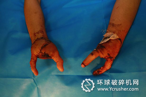 傷者的手接成“螯”狀。